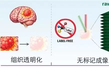 快速生成胶质瘤毫米级三维病理图像，中国学者在《细胞》杂志发文